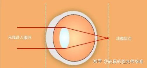 离焦镜片有用吗?不同离焦镜片的离焦量该如何选择? - 知乎