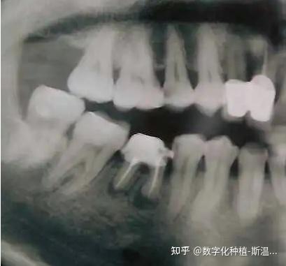 什么情况需要做根管治疗？牙髓炎vs根尖炎都是什么？有什么症状？ - 知乎