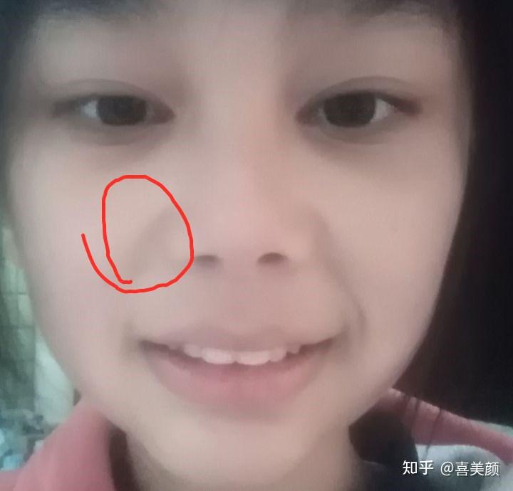 笑起来时鼻子突出来的那两块肉是什么