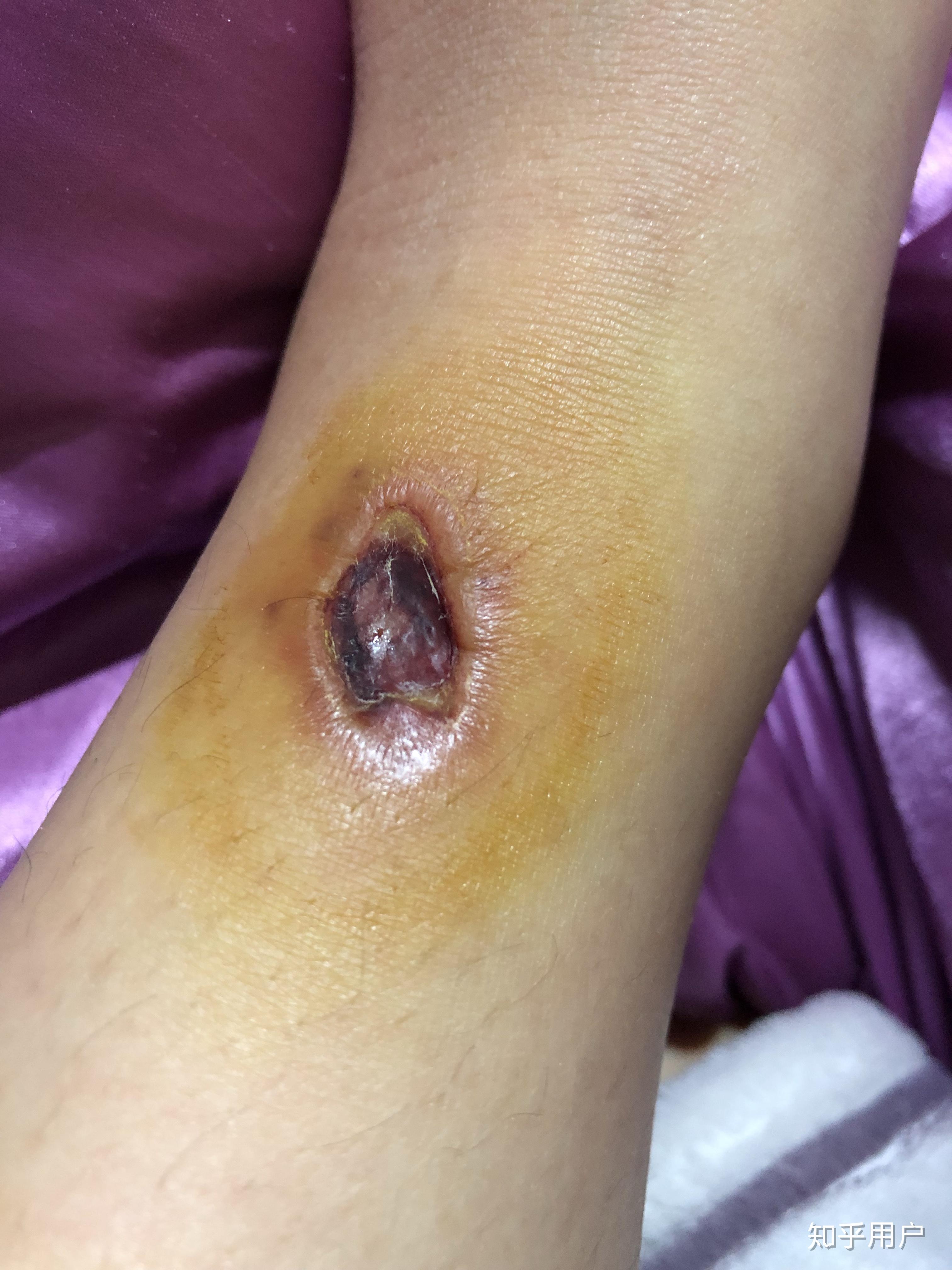被毒蚊子咬了 肿了很大一个包 还很硬 之后肿的包上面起了水泡 挑破