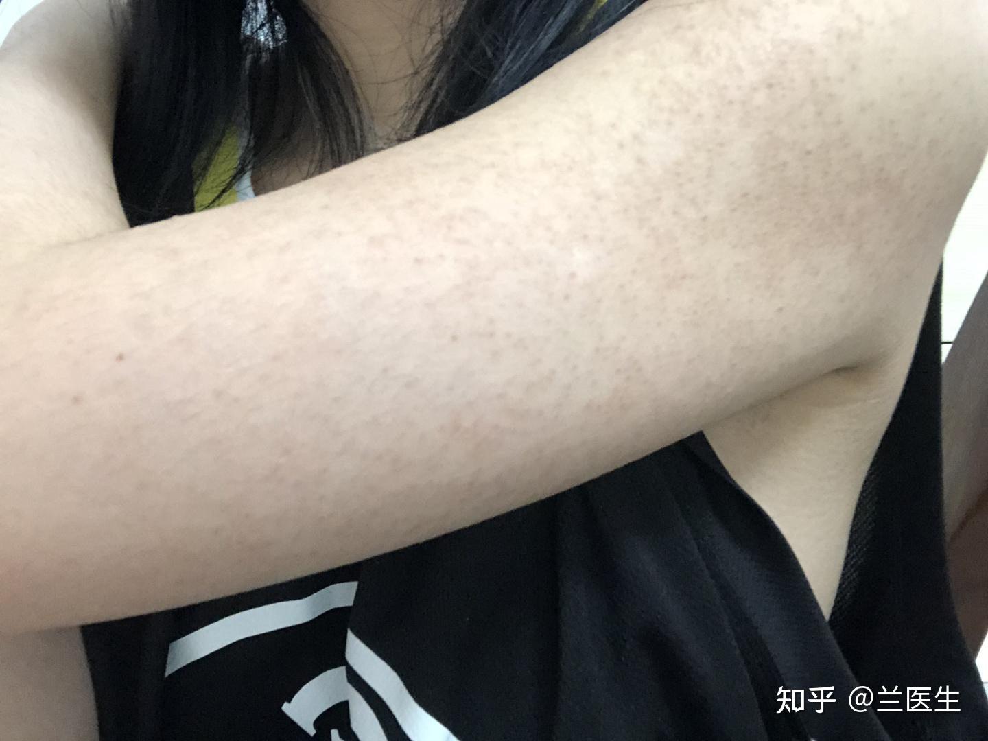 胳膊上这是鸡皮吗? - 知乎