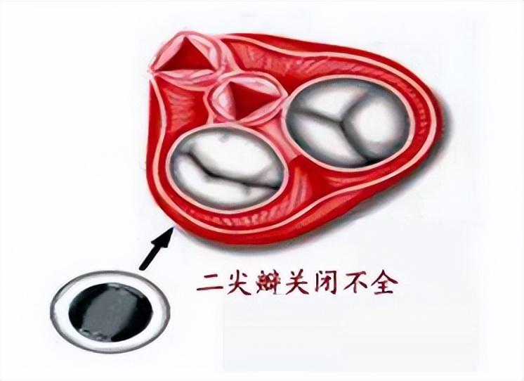 二尖瓣城墙样改变图片