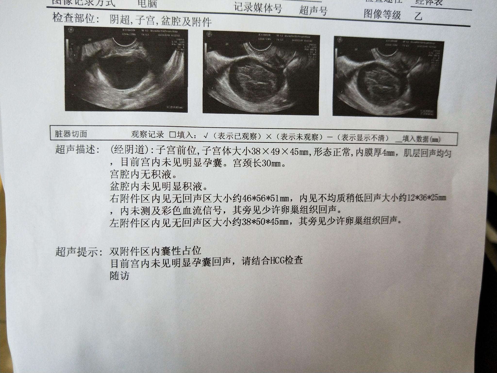 怀孕初期左侧有囊肿怎么办？ - 知乎
