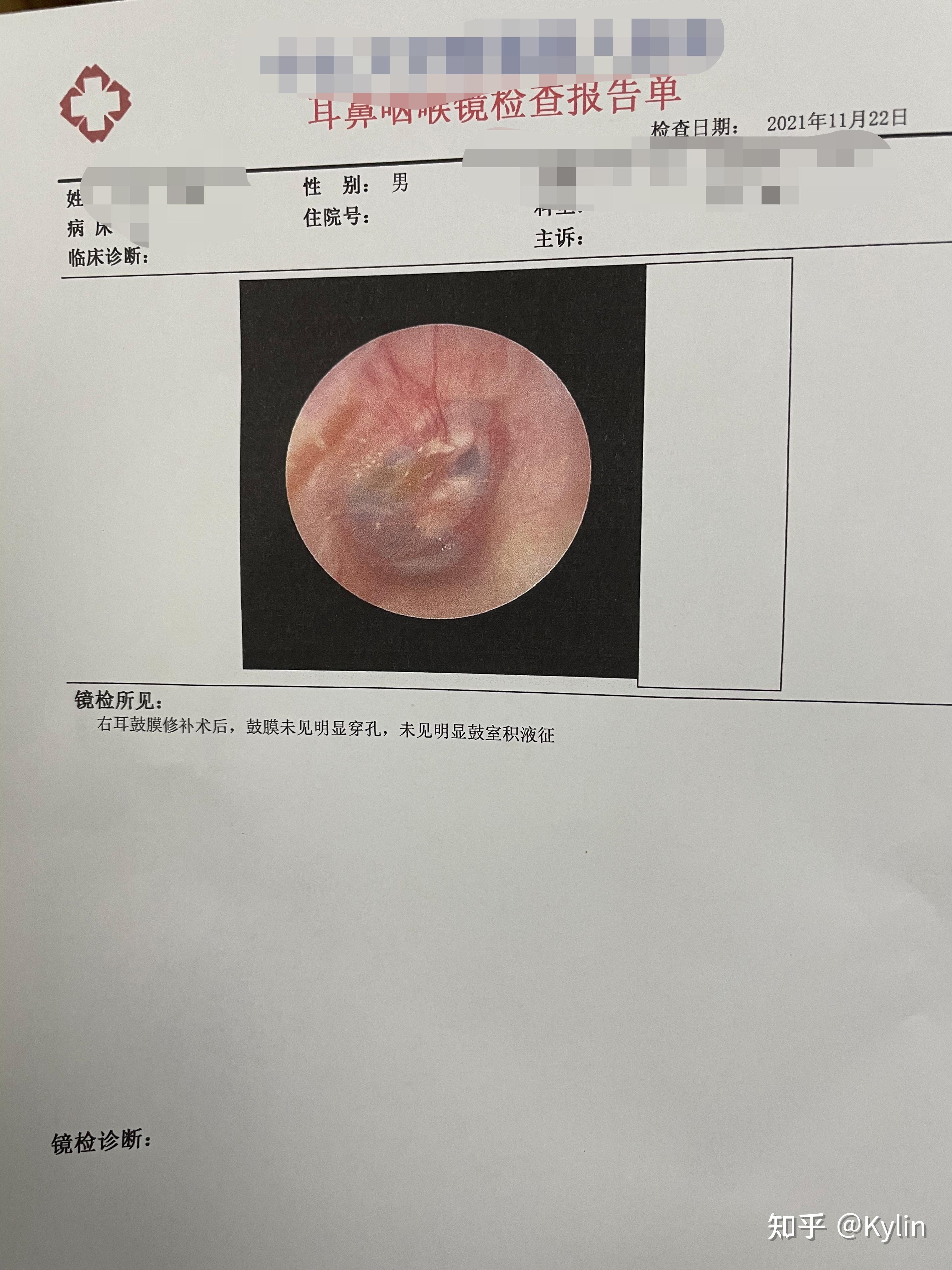 耳膜穿孔修復手術全過程記錄第五天出院了20220611更新已康復