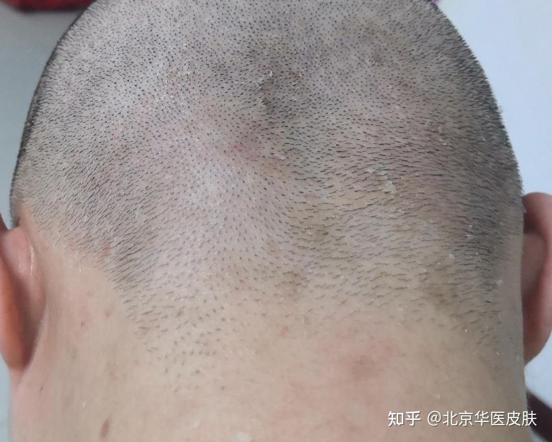 脂溢性皮炎的症状有哪些 - 知乎