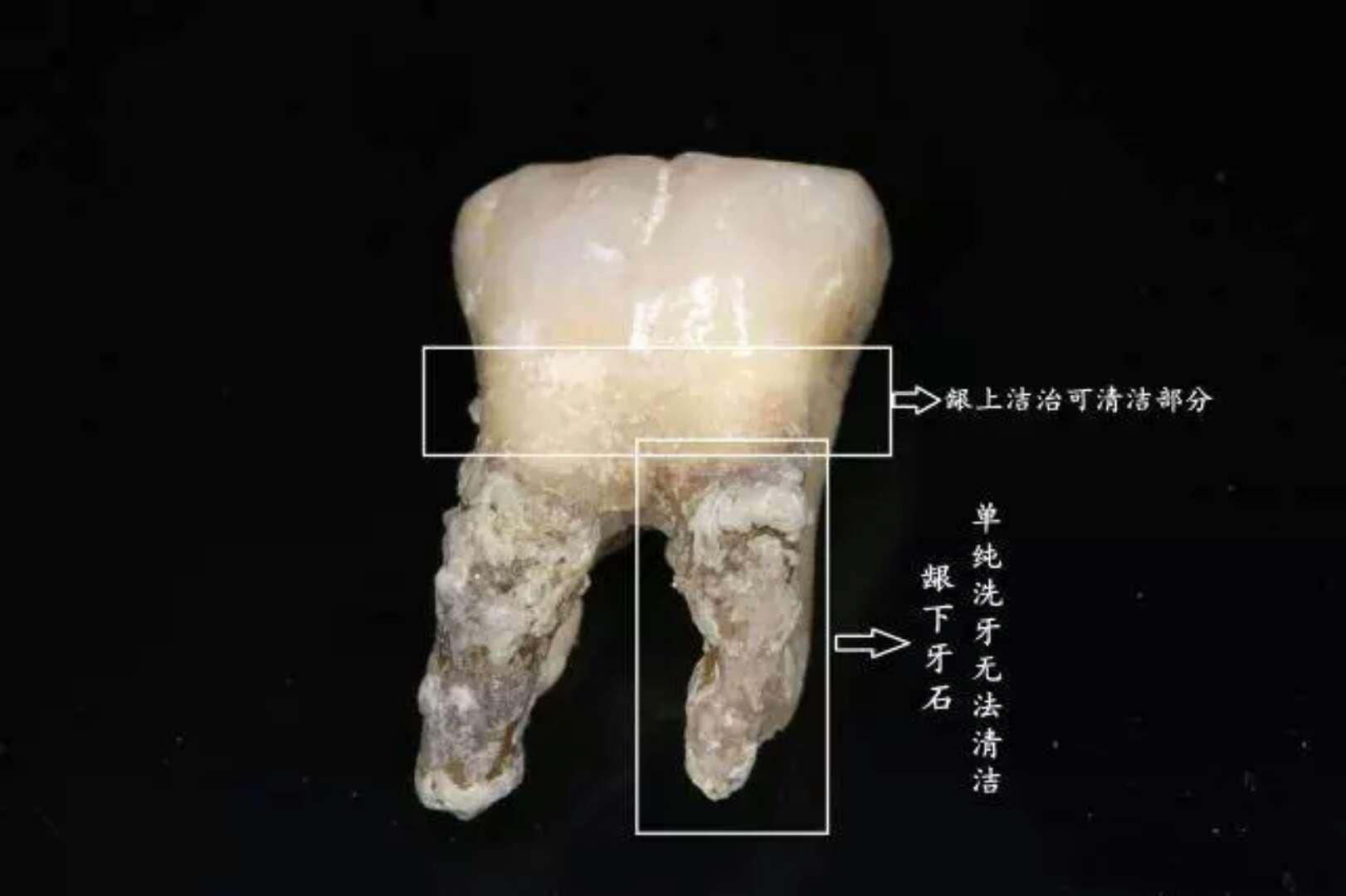 【襄阳牙牙口腔】为什么孩子的牙齿是锯齿状牙齿？ - 知乎