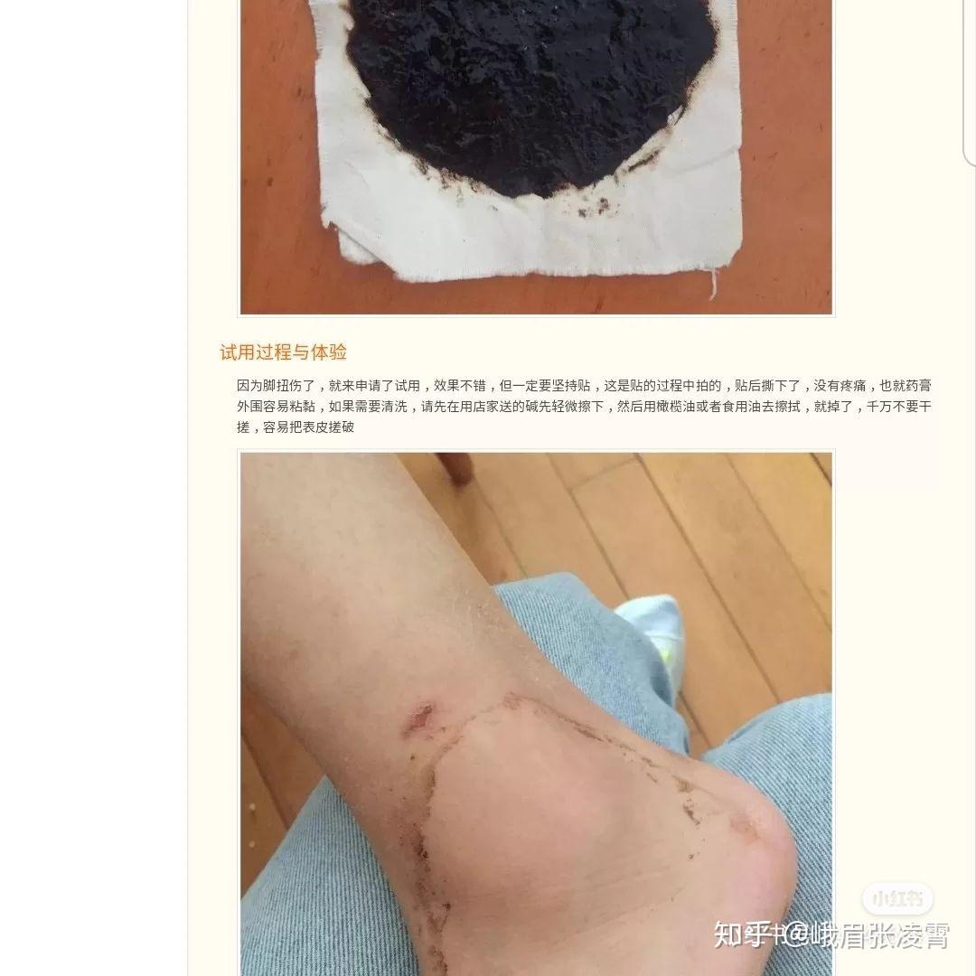 脚后跟有少量积液怎么治疗