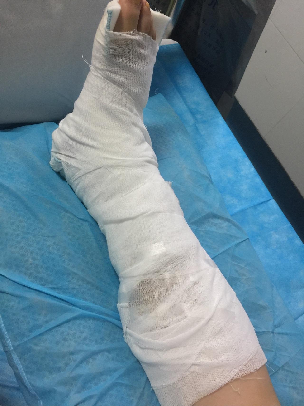 骨折是一种什么样的体验? - 知乎