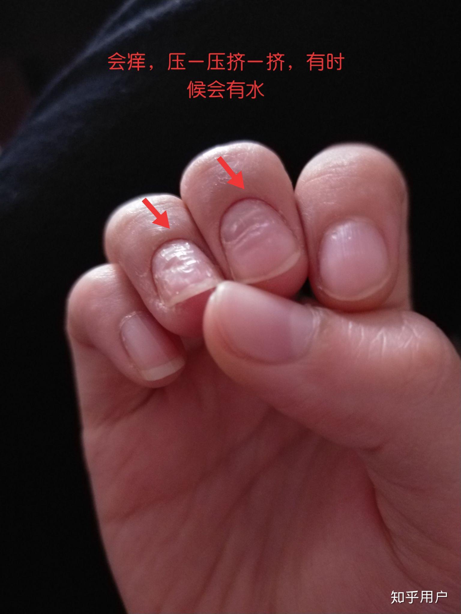 手指甲凹凸不平没检查出原因