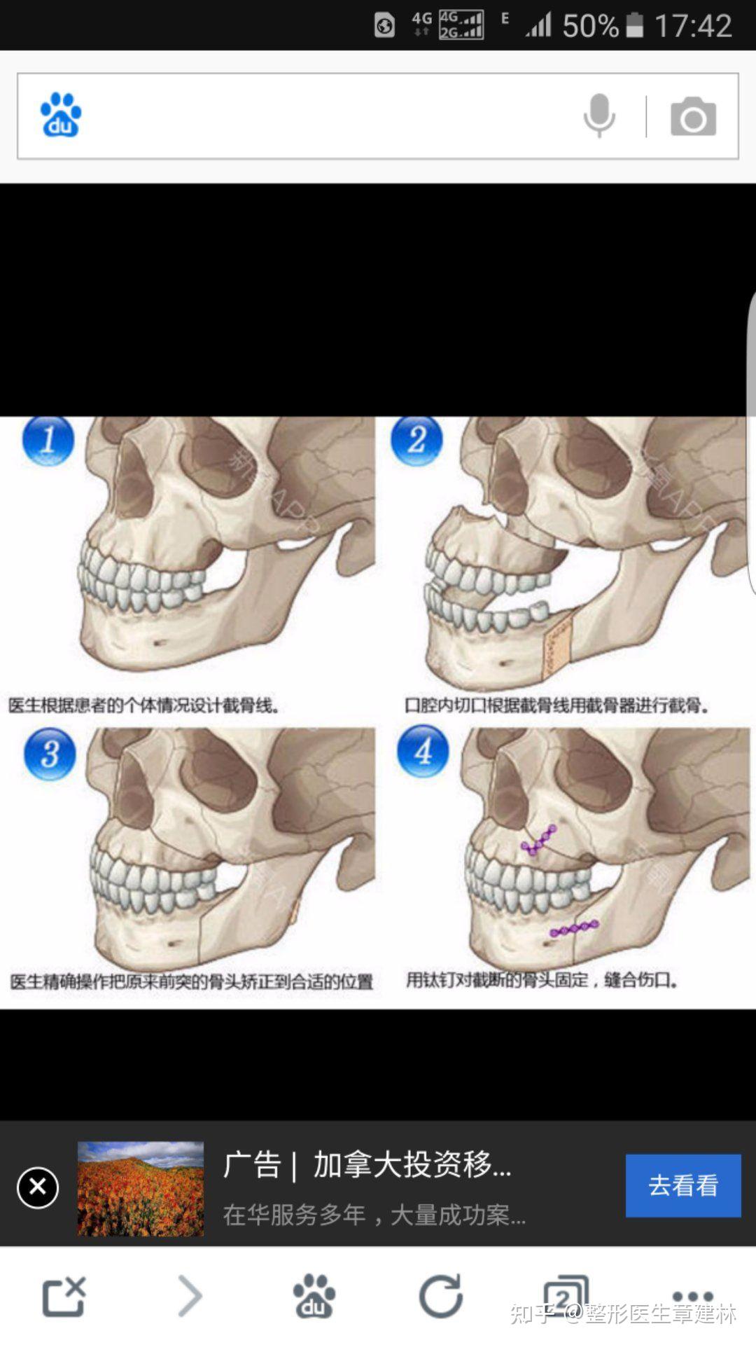 “换”下巴——下颌骨重建 - 好大夫在线