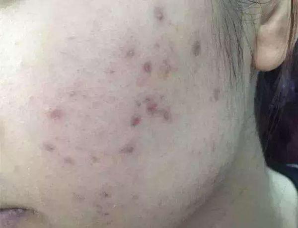 脸上有痘痘、痘印就不要这样做啦~ - 知乎