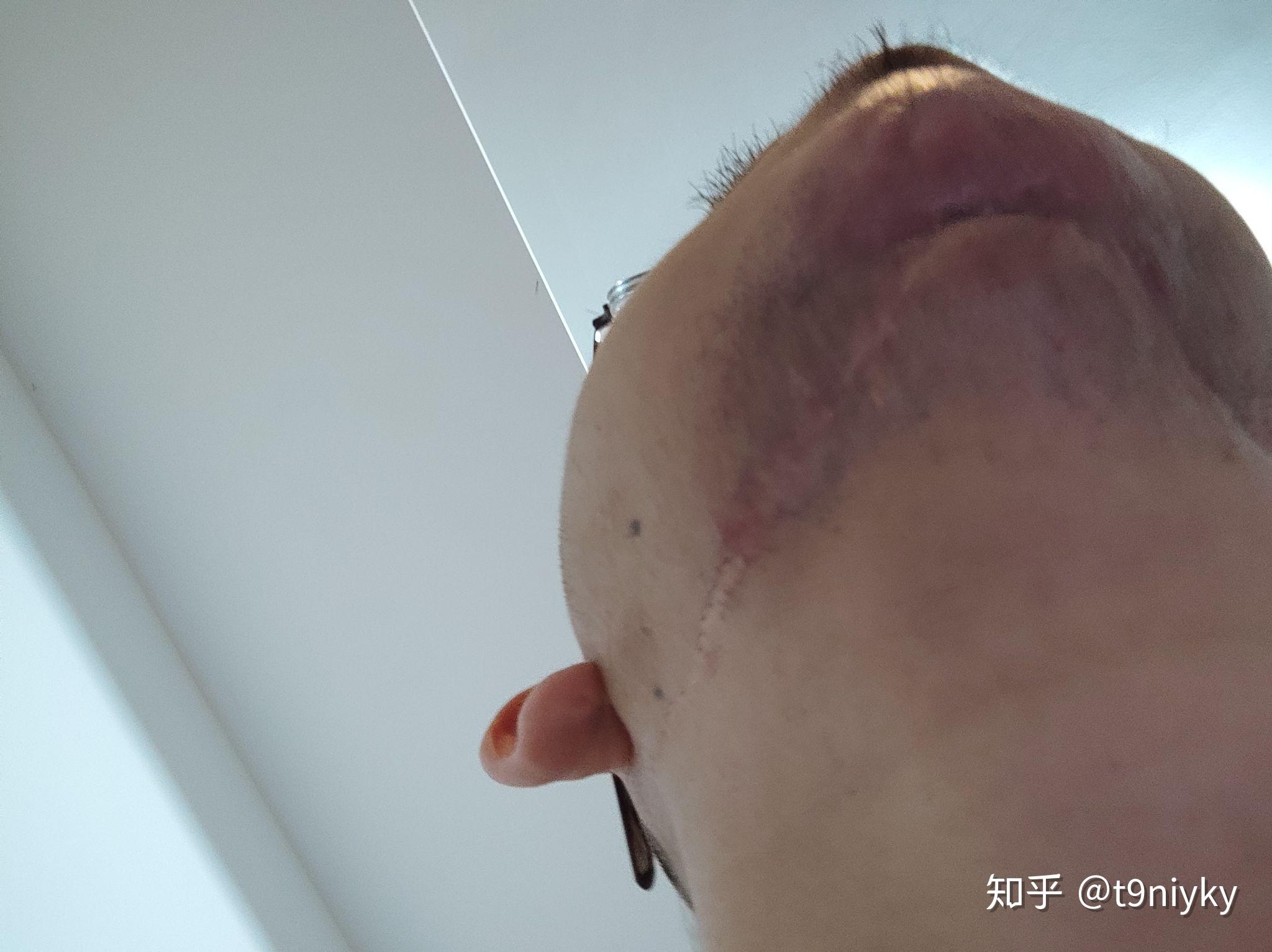 注射唑来膦酸导致下颌骨骨髓炎,请问有什么办法或者哪个医院能治疗?