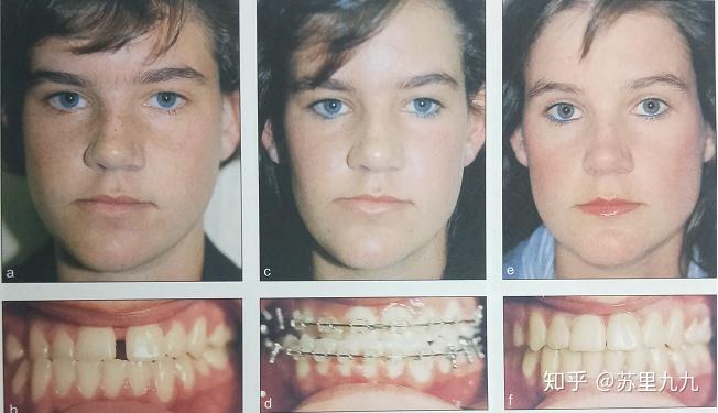 对于成年人牙颌面不对称畸形可以根据不同