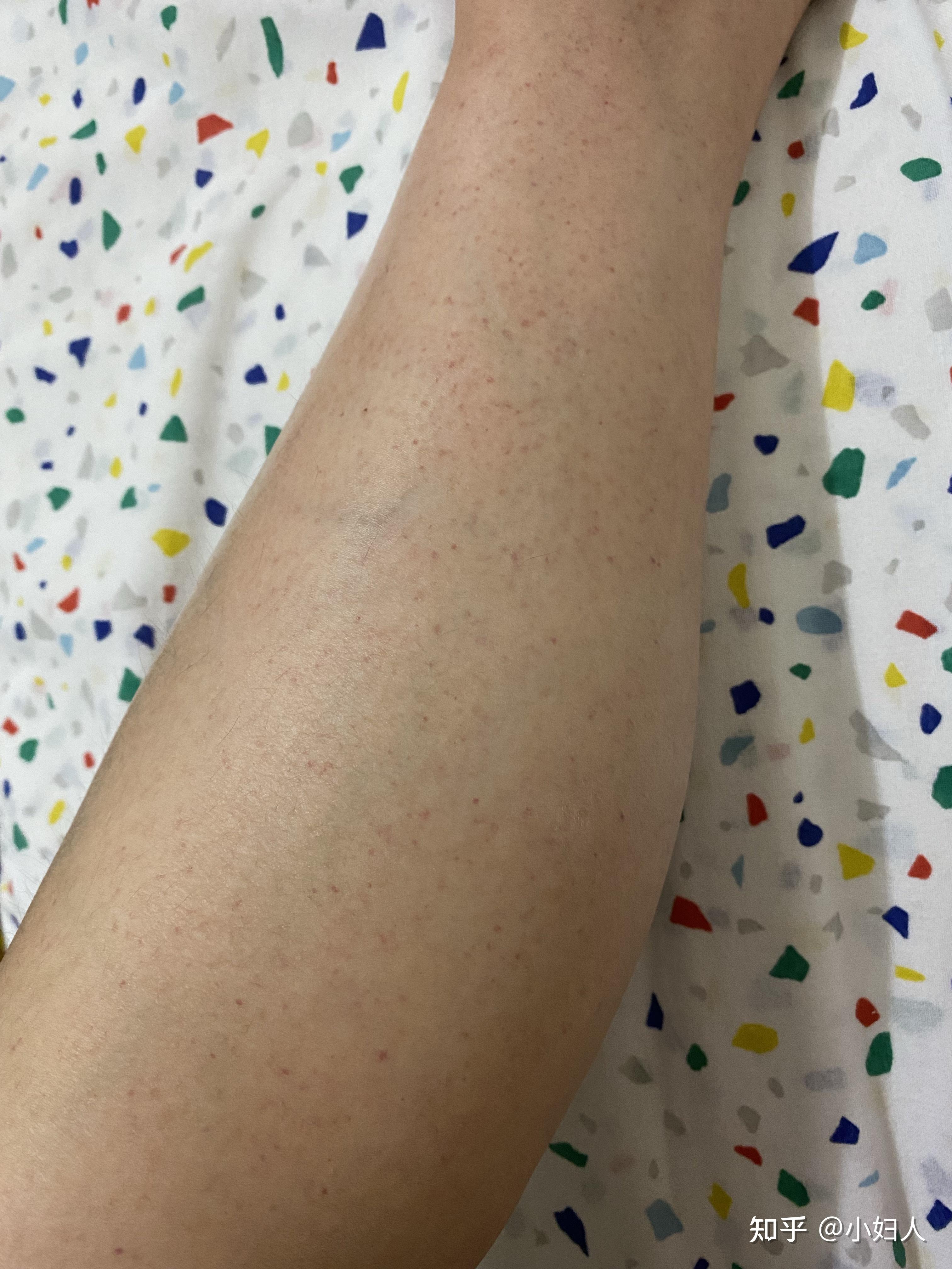 荨麻疹血管炎是很严重的病吗有得同样病的人吗