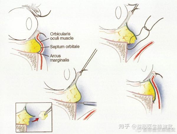 眶隔脂肪释放术的原理和历史 - 知乎