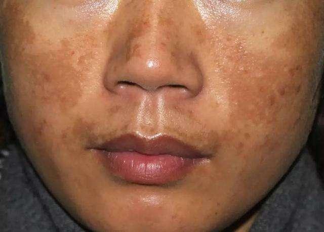 黄褐斑能彻底治好吗赵小姐30天就把成片的斑去掉了你不试试