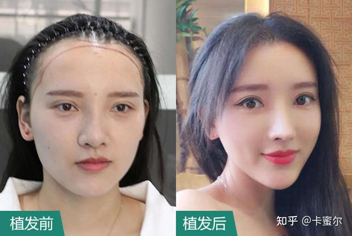 植发头发会掉么(植发的头发会不会掉)