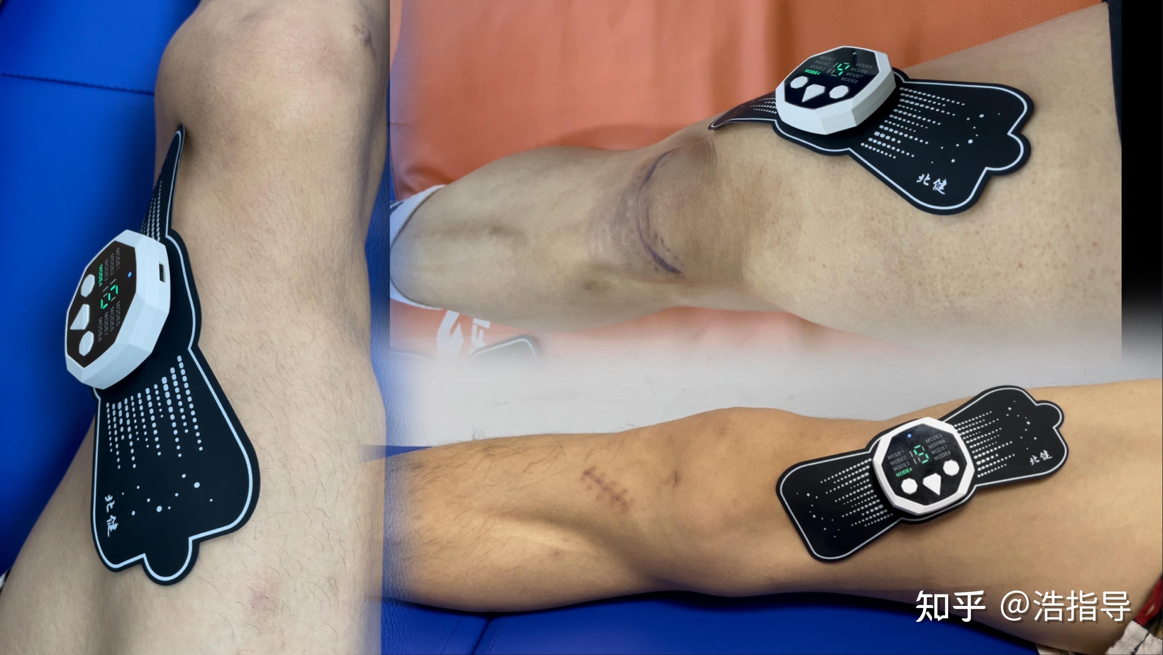 迷你肌肉电刺激,肌肉萎缩专用,高效训练肌肉 - 知乎