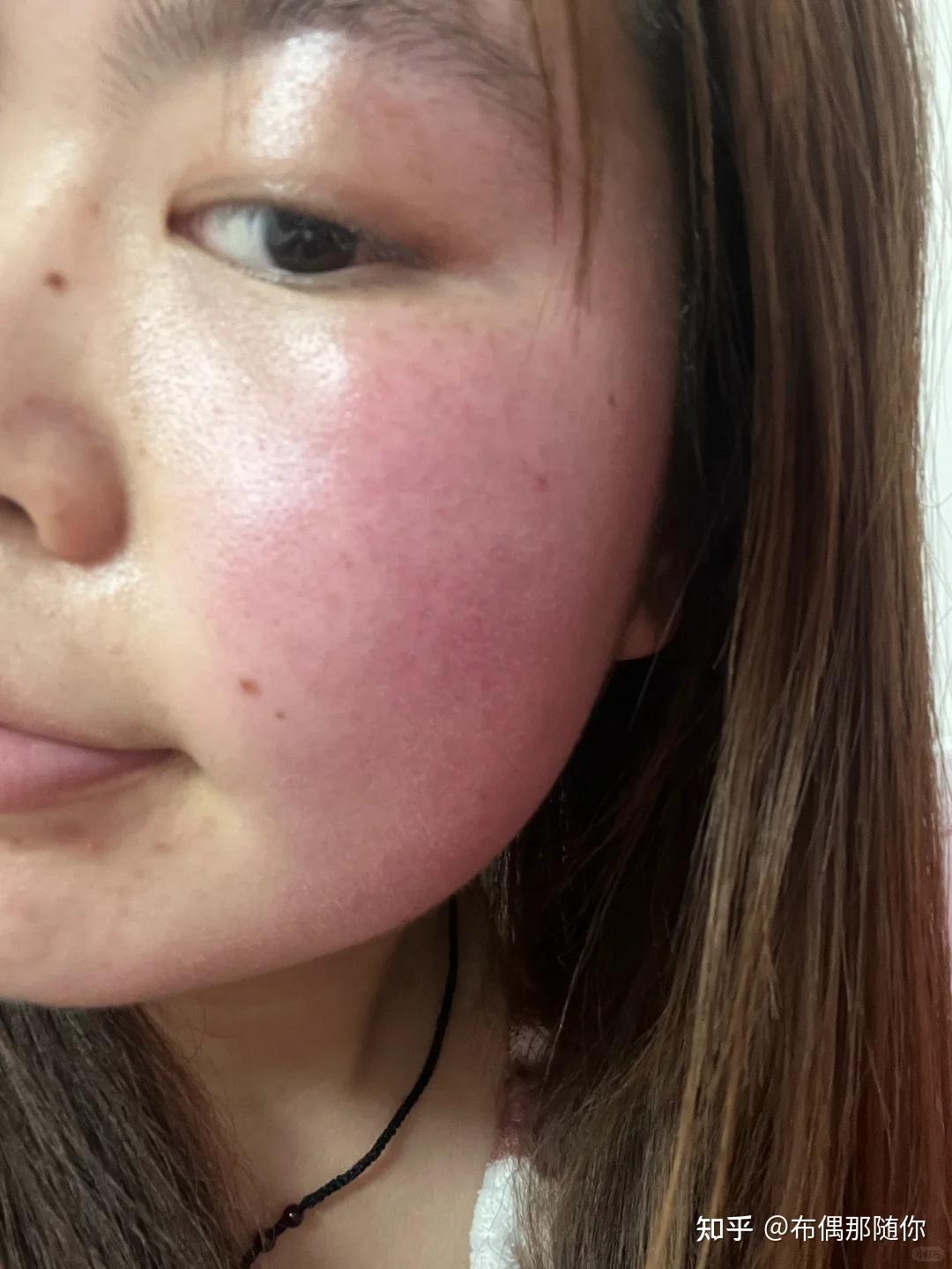 从医学角度来说,换季脸上总是泛红敏感怎么办?