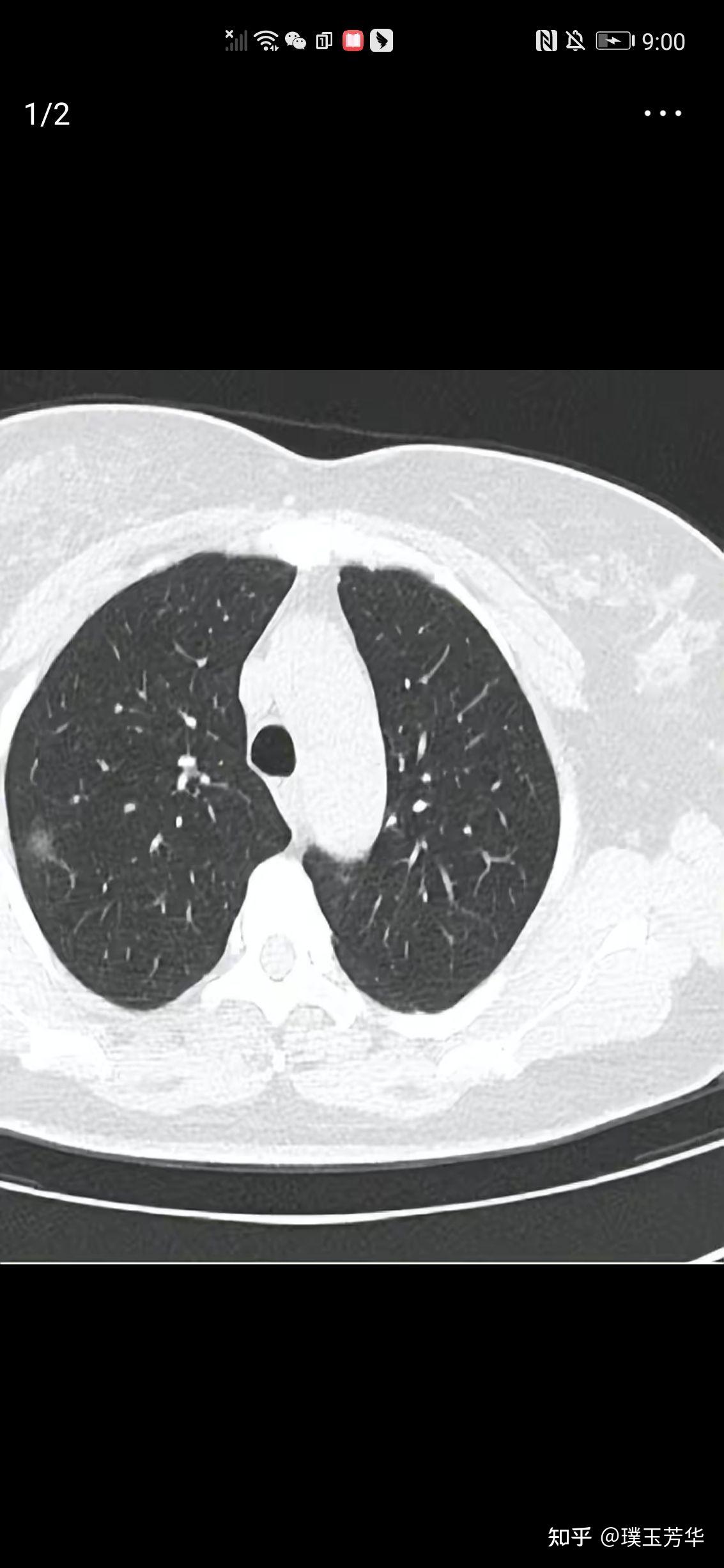 肺癌卫星结节图片