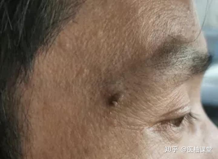 黑痣癌变67从发病到去世不到两个月这些痣千万要小心