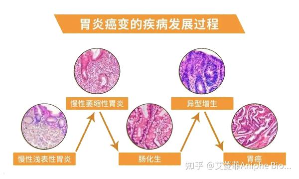 疾病模型|慢性萎缩性胃炎(CAG)与胃癌(GC)上 - 知乎