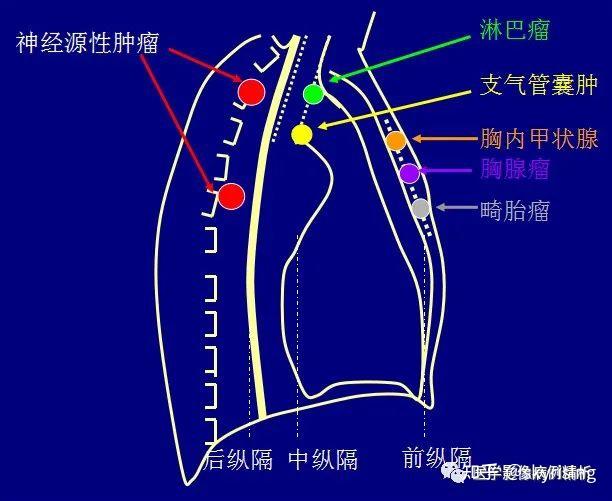 纵隔淋巴结钙化图片