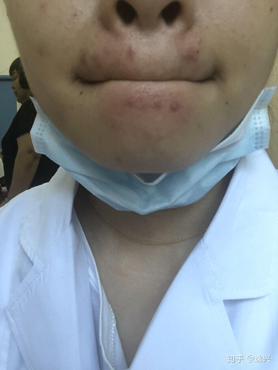 唇周不停长痘怎么办