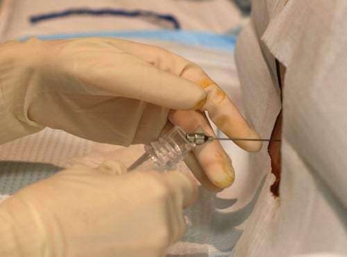 腰穿多久出结果