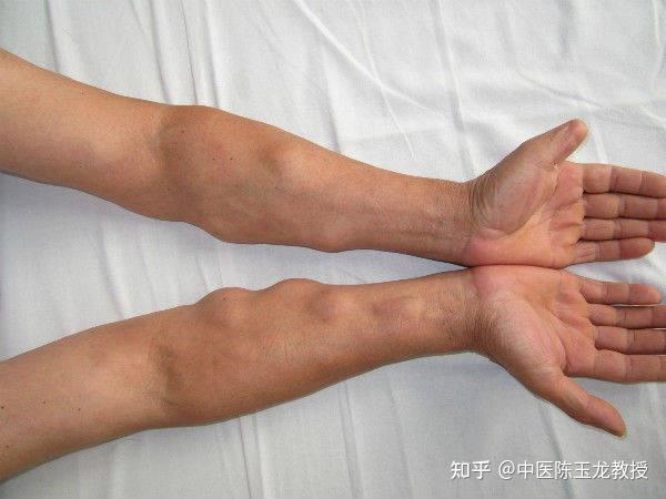 分享一个消脂肪瘤经验方,健脾祛湿,理气化痰散结,可治“痰核” - 知乎