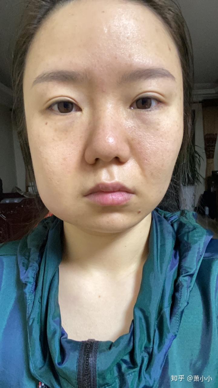 拔水平阻生智齿,术后第二天脸肿了,请问几天能消肿? - 知乎