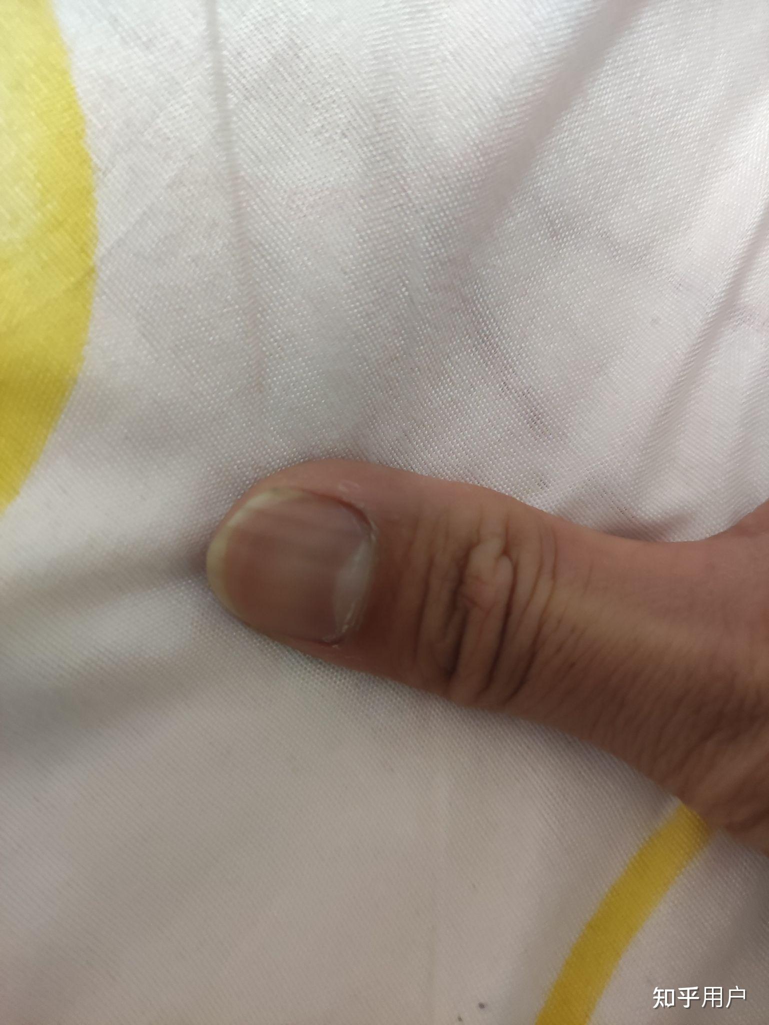 左手大拇指指甲有一条淡褐色竖线好几年了微量元素也正常为什么啊