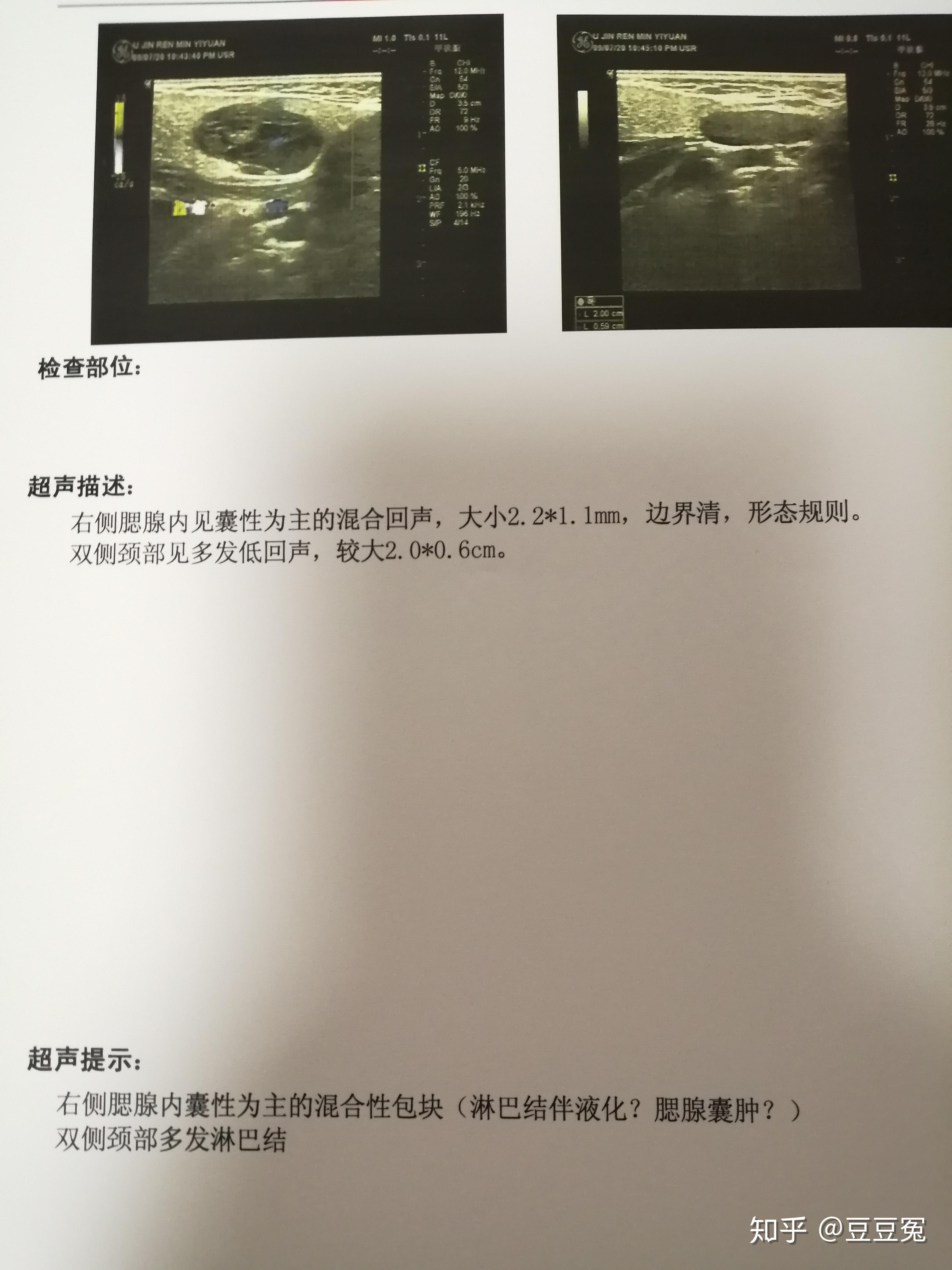 腮腺里囊性为主的混合型包块淋巴结化液化腮腺囊肿见b超图