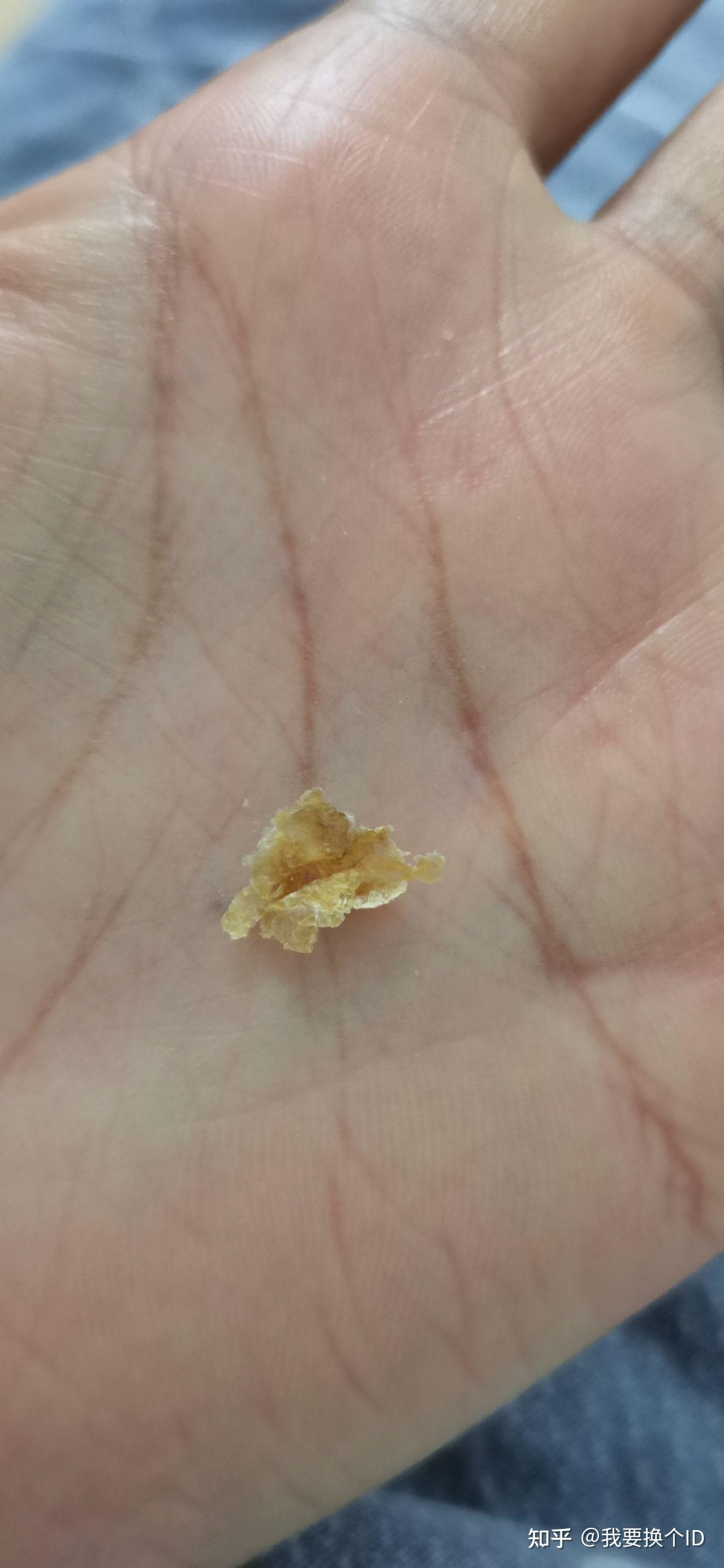 为什么我从来没掏出来过大号的耳耵聍? - 知乎