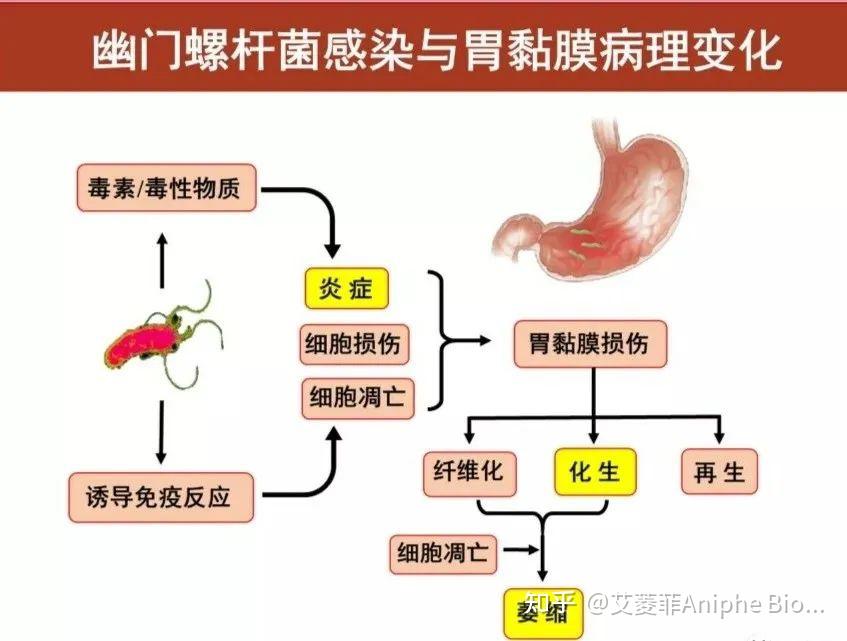 疾病模型慢性萎缩性胃炎（cag）与胃癌（gc）上 知乎 