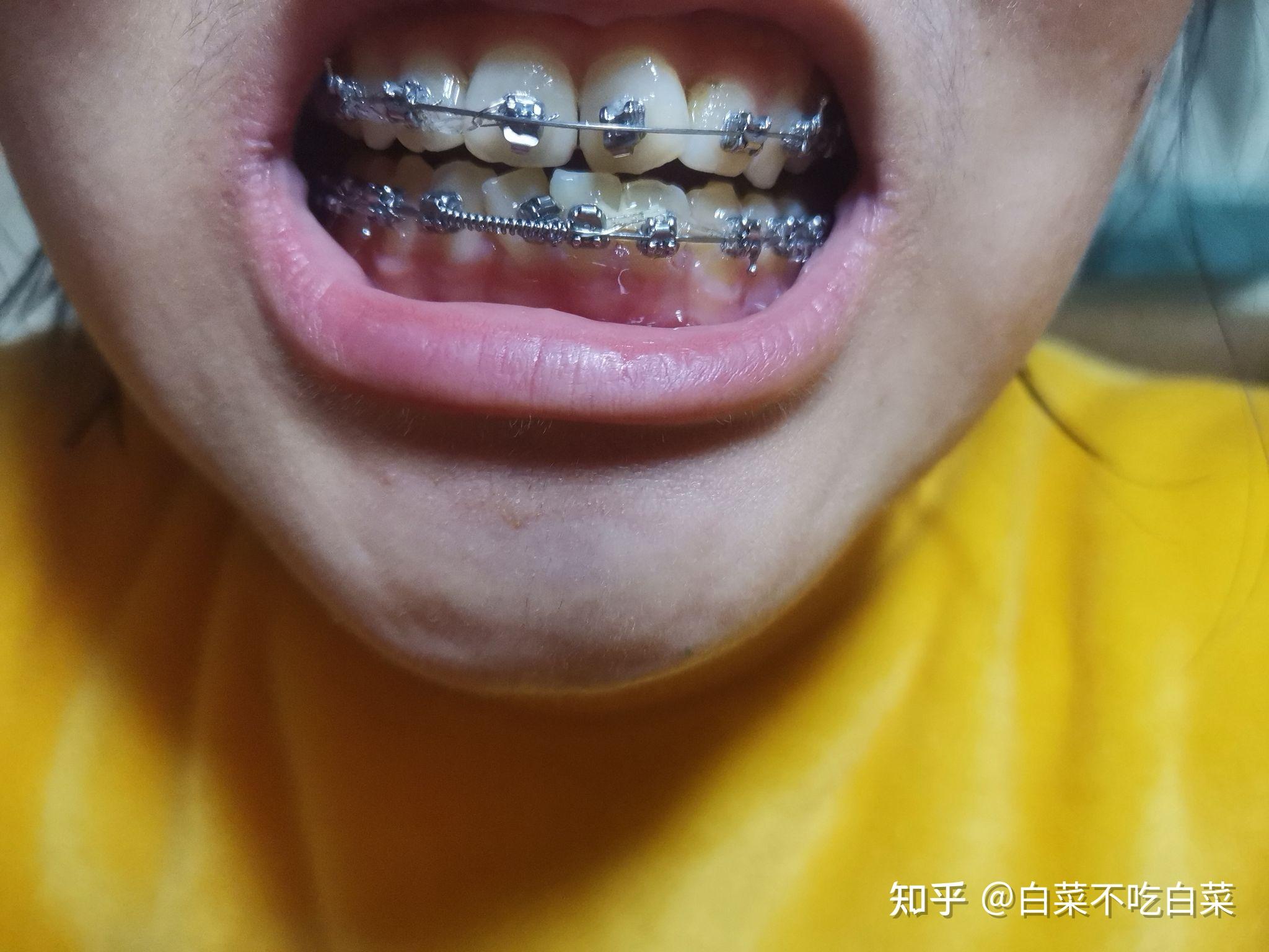 牙套(已拆) - 知乎