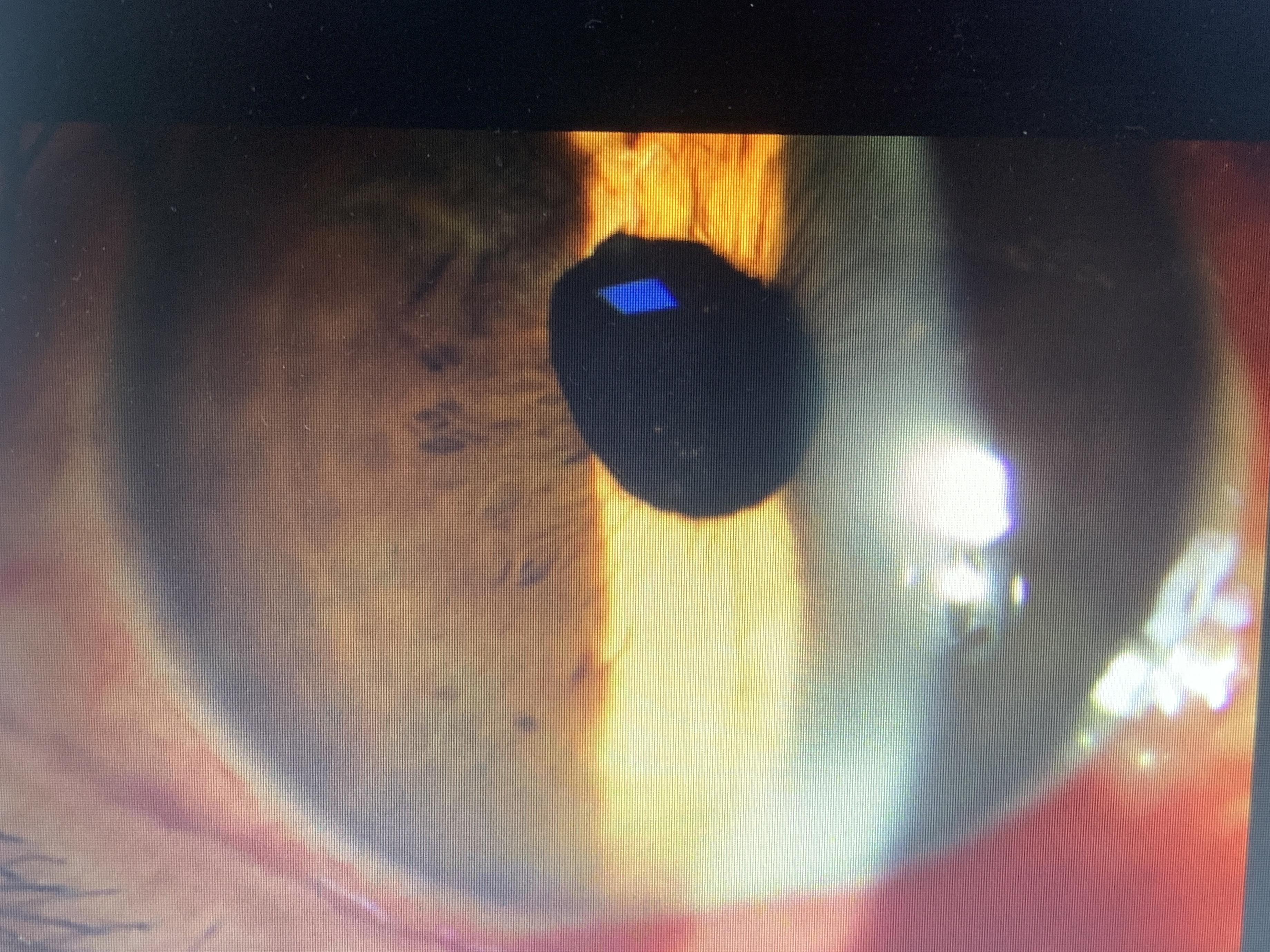 一例脉络膜脱离型视网膜脱离病例分享