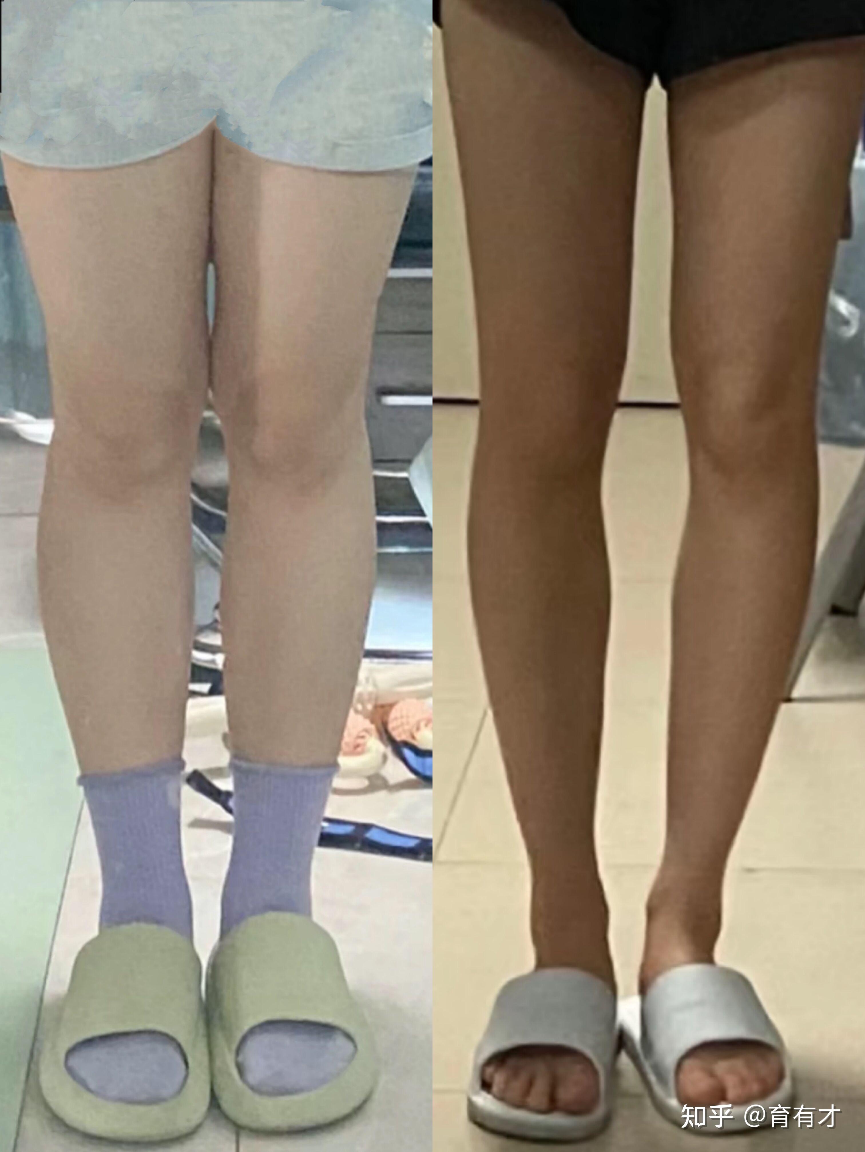 梨形瘦腿坚持改善大腿前侧的变化