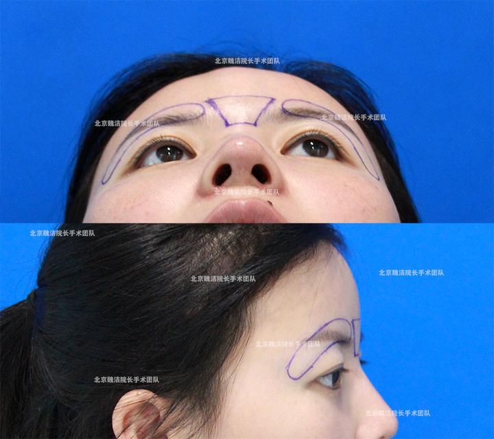 垫眉弓手术不是独立的 务必兼顾眉心及额颞部的衔接过渡 方可获得自然柔和的眉骨形态 - 知乎