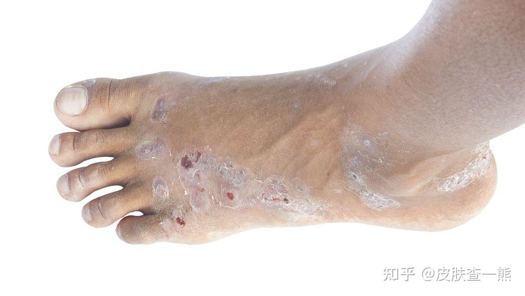 【查说菌毒】脚气灰指甲所属的真菌感染到底是个啥?