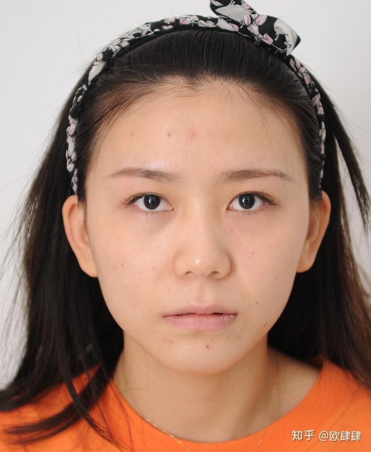 真人案例73路人如何拥有张柏芝同款鼻子