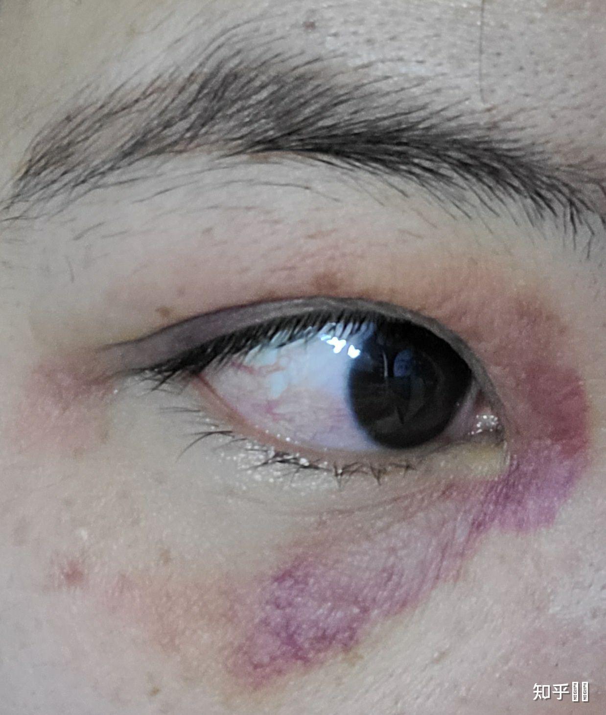 想知道眼部淤青怎么可以快速消除? - 知乎