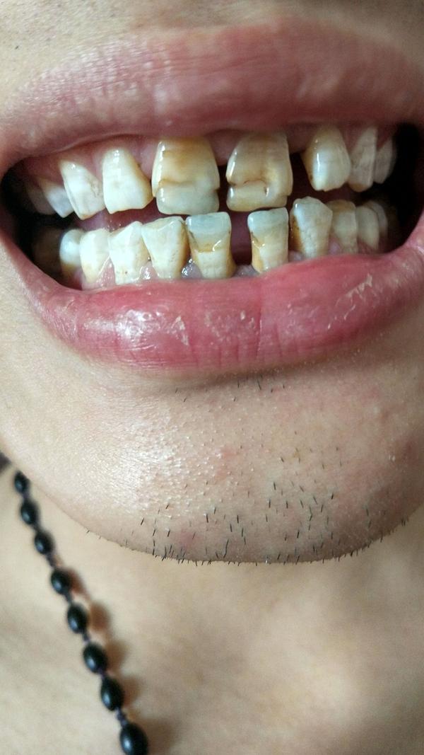 一口牙到底能坏成什么样?