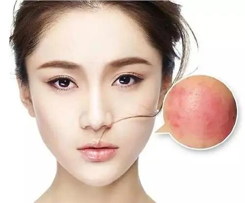 【兰肤妍小课堂】什么是油敏皮 - 知乎