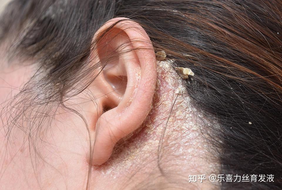 戴假发有什么危害?