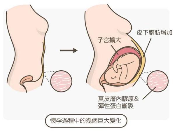 妊娠纹的成因及变化过程 知乎