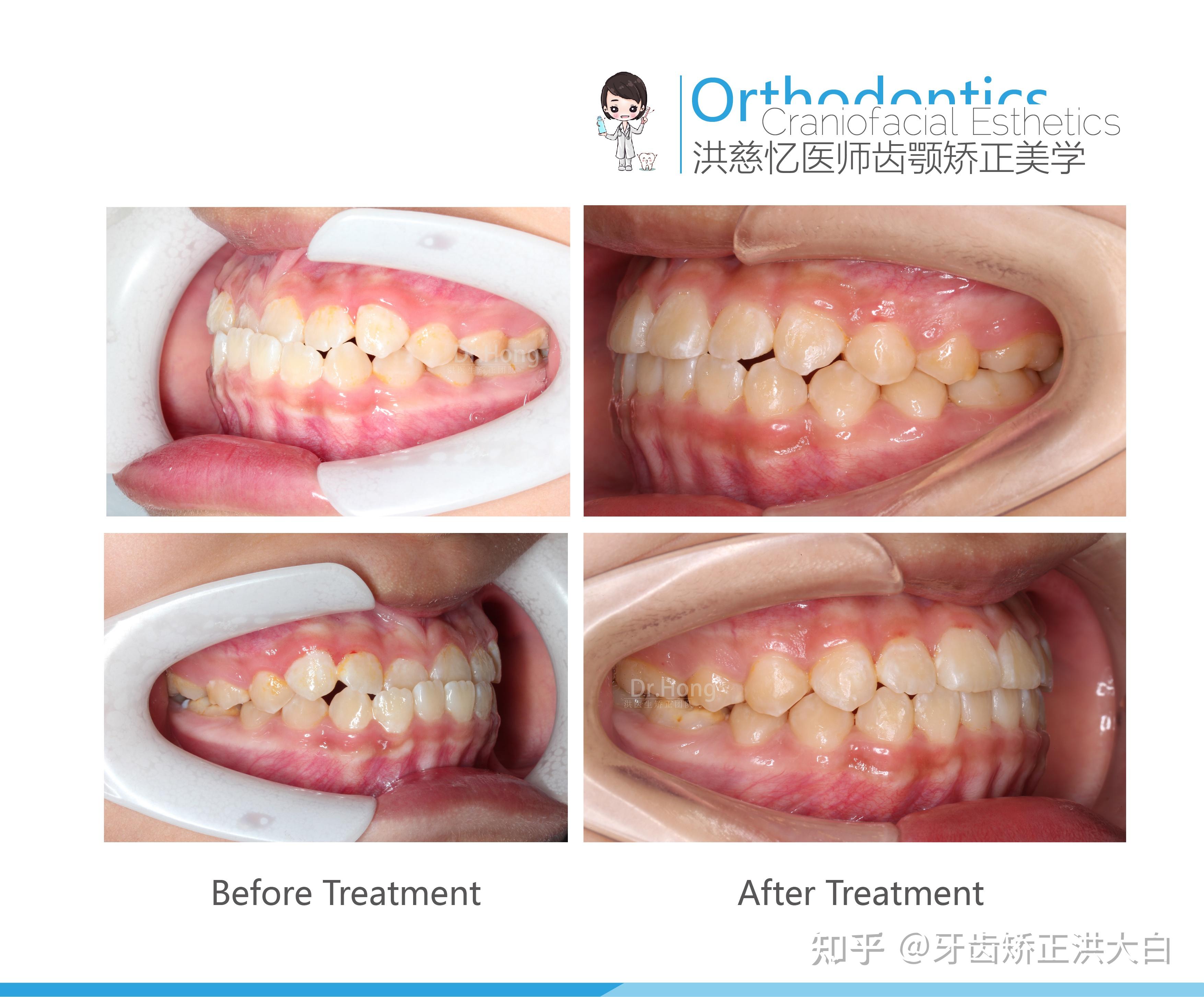 牙齿矫正对比照侧面图片