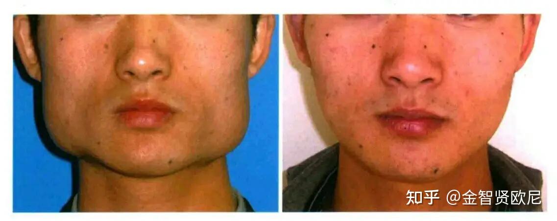 男生发腮如何用医美手段高效解决? - 知乎