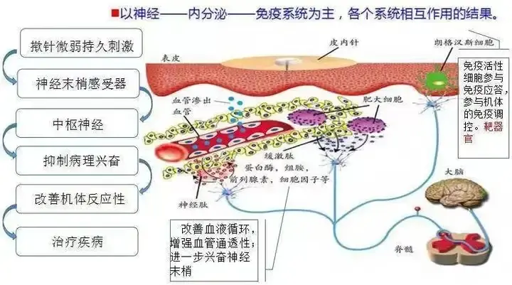新型中医揿针（皮内针）疗法的原理 - 知乎