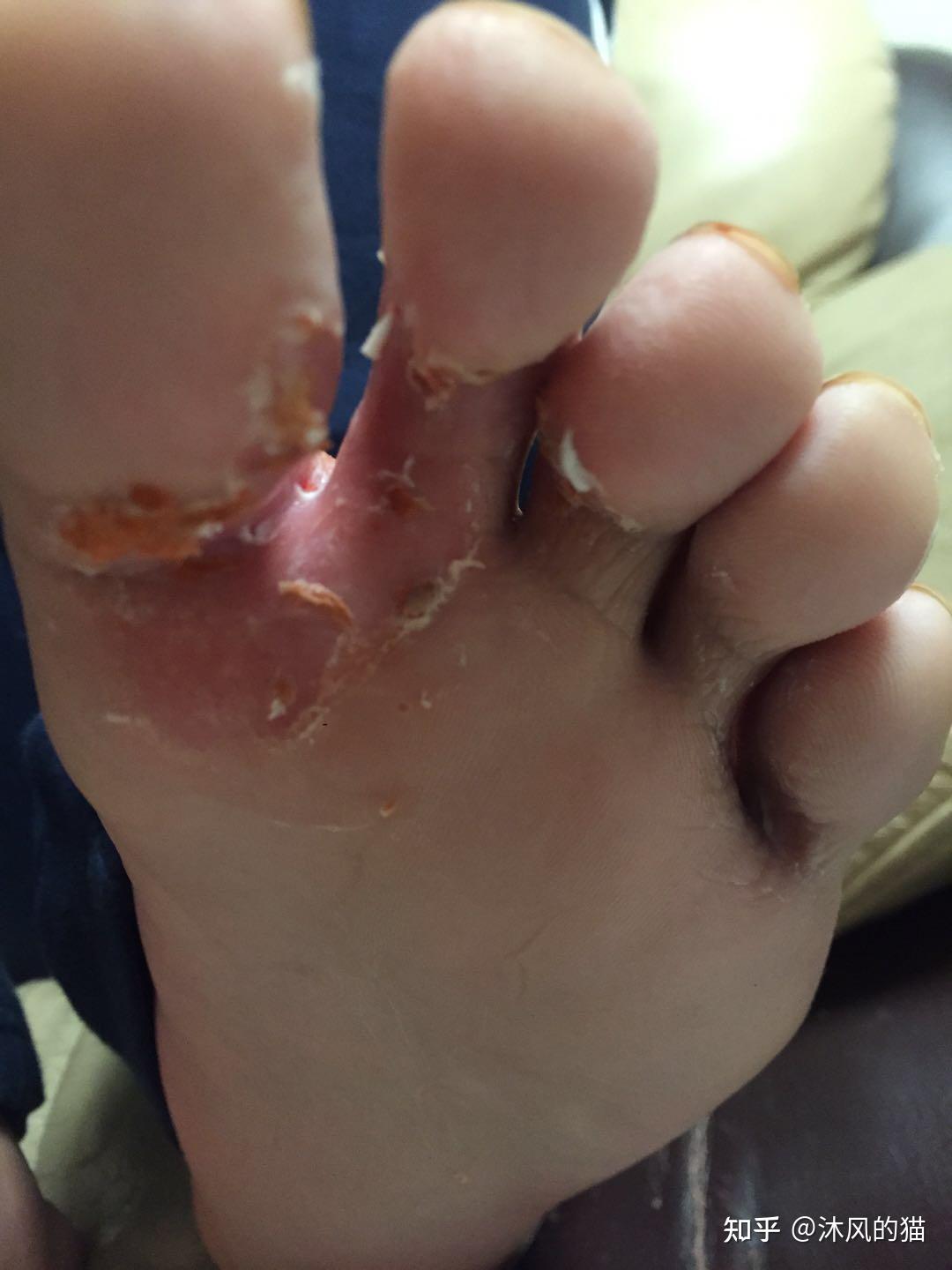 真菌感染的足藓可以根治吗